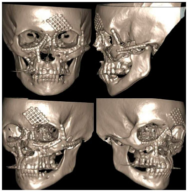 Cirurgia crânio maxilo facial: tratamento das fraturas dos ossos do crânio